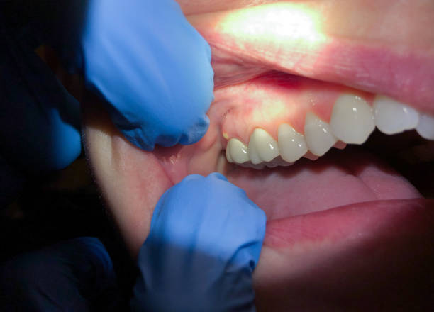 Best Emergency Dental Care for Broken or Chipped Teeth in Collins, MS